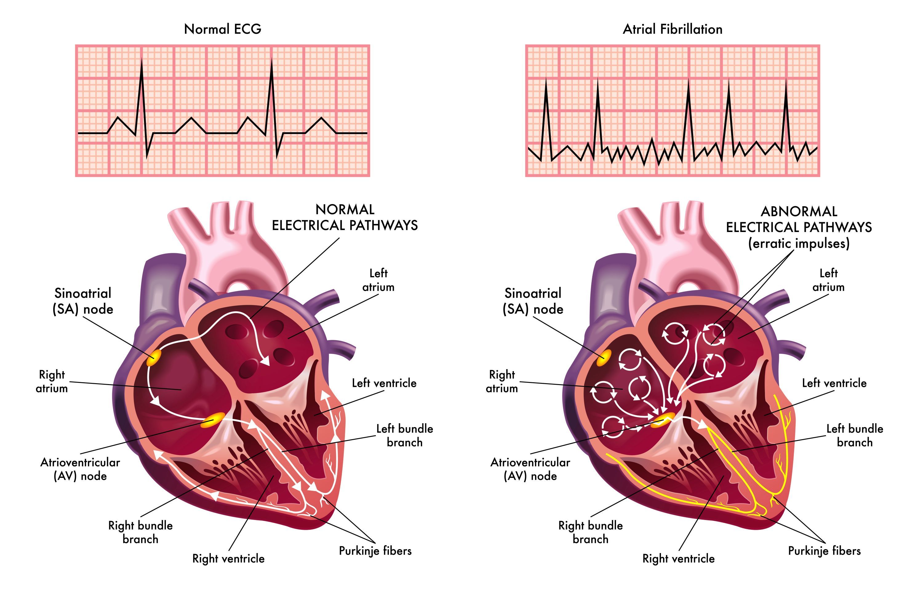 What Is The Main Difference Between Atrial Fibrillation And Atrial Flutter